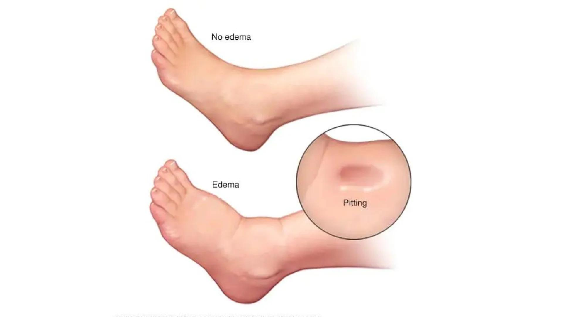 Edema FAQs  Meri Sehat