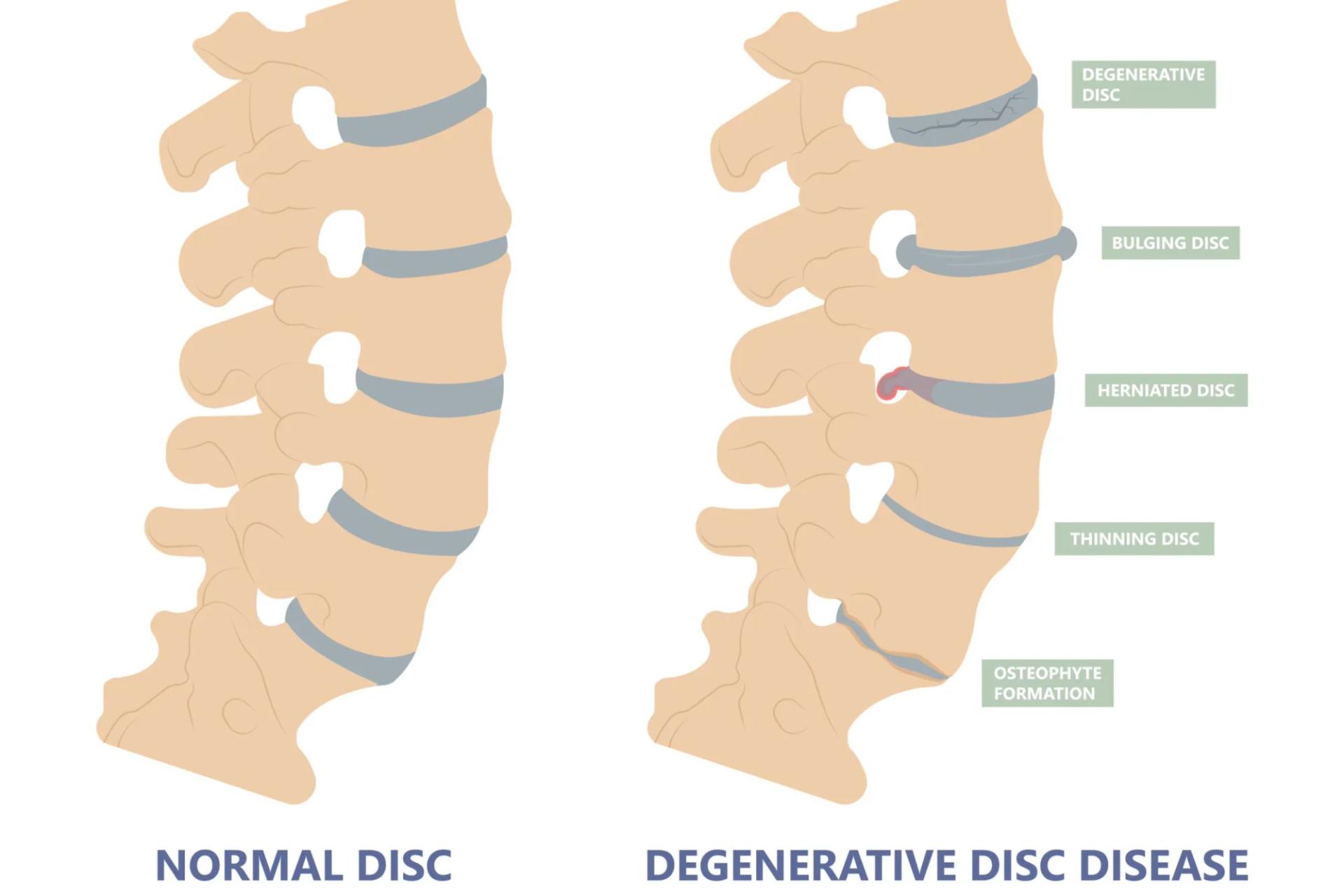 Effective treatment for degenerative disc disease with Meri Sehat