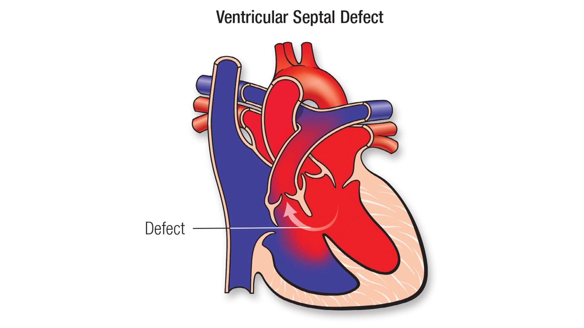 Ventricular Septal Defect Causes Symptoms and Treatment Meri